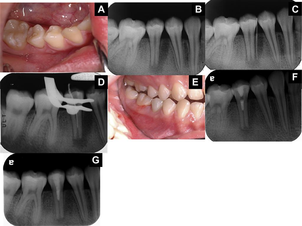 Immature teeth treated with triple antibiotic paste 199 Figure 4 (A) Photograph showing a sinus tract on the alveolar mucosa between teeth 28 and 29.