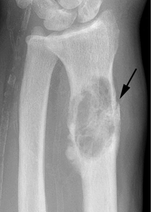 Case Report The patient is a 58-year-old right-hand dominant male, who was referred to our institution for evaluation of a right forearm mass.