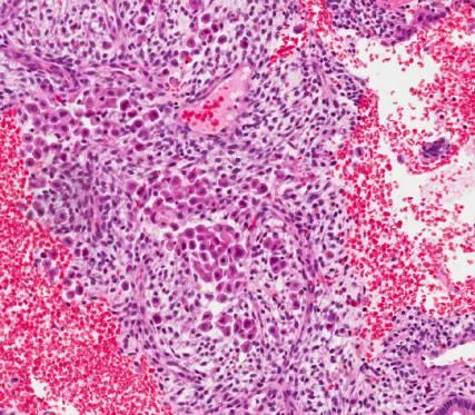 Case 6 Case 6 Diagnosis :Metastatic lobular carcinoma of breast Case 6 Immunohistochemistry EMA