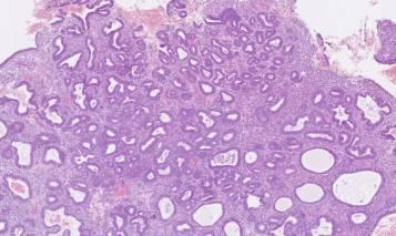 Precursor lesion of HGSC Cytologic features in