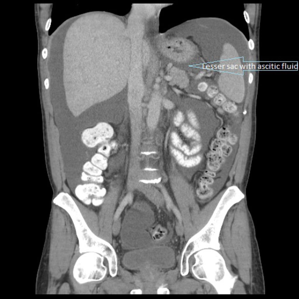 Fig. 6: Abdominopelvic CT showing ascitic fluid in the lesser