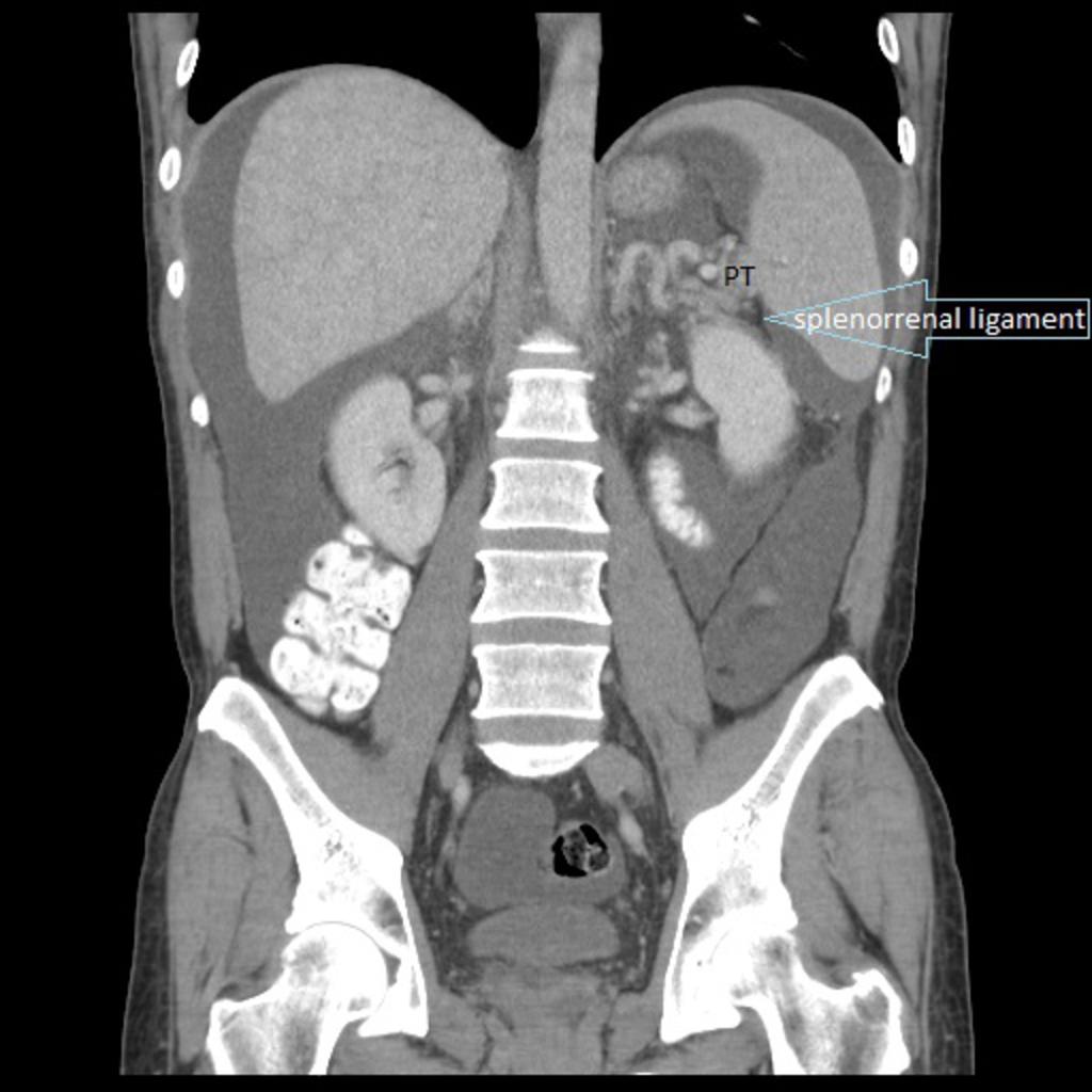 Fig. 9: Abdominopelvic CT of a patient with ascites, showing the