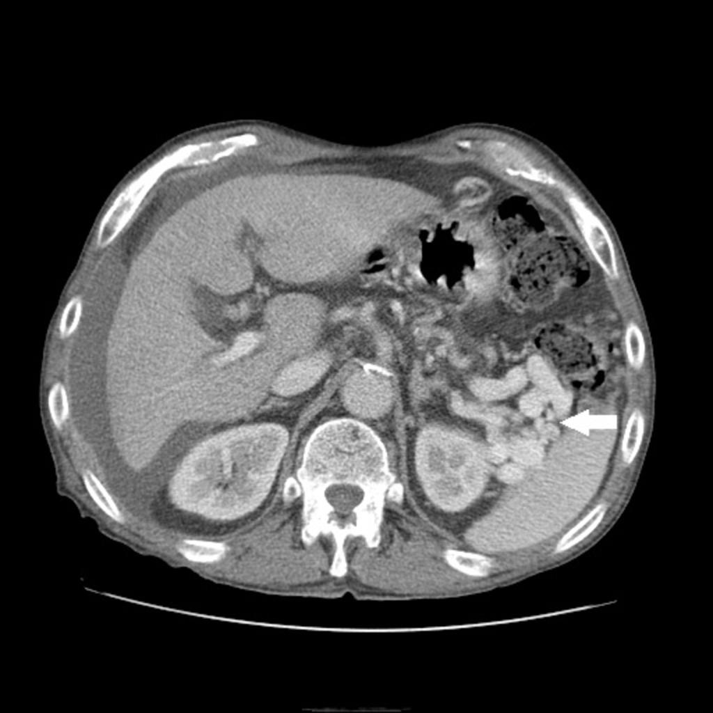 Fig. 10: Example of a pathology that can manifest in the splenorenal ligament: Abdominopelvic CT of a