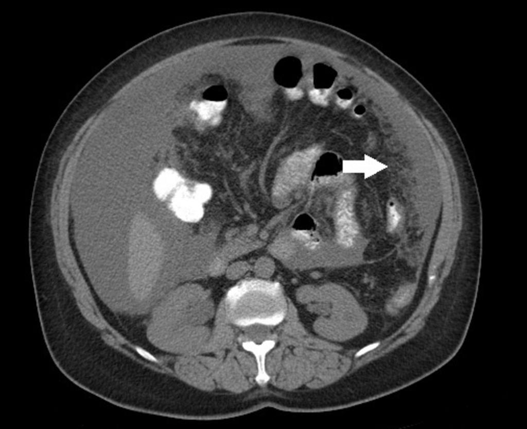 Fig. 11: Example of a pathology that can affect the greater omentum: Abdominopelvic CT of a patient with adenocarcinoma of the