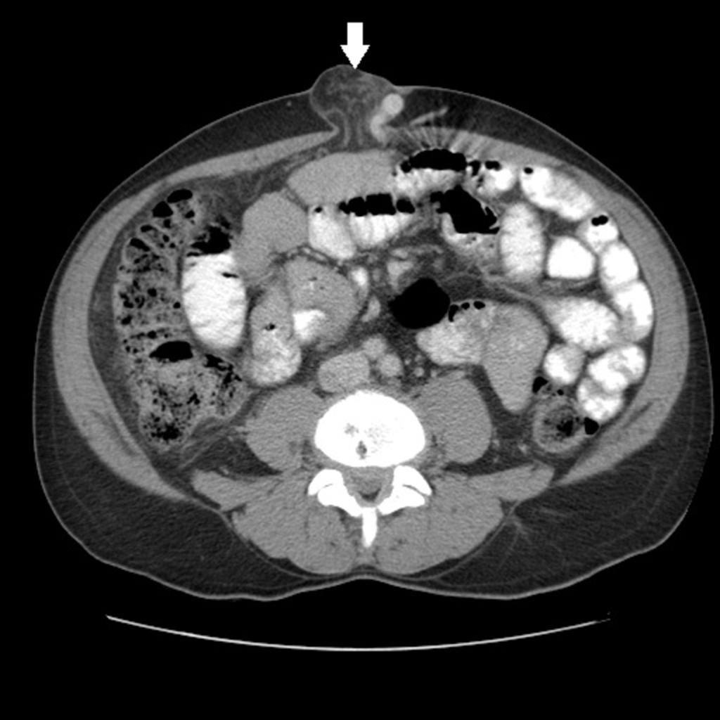 Fig. 12: Example of another pathology that can affect the greater omentum: Abdominopelvic CT of a patient with hepatic