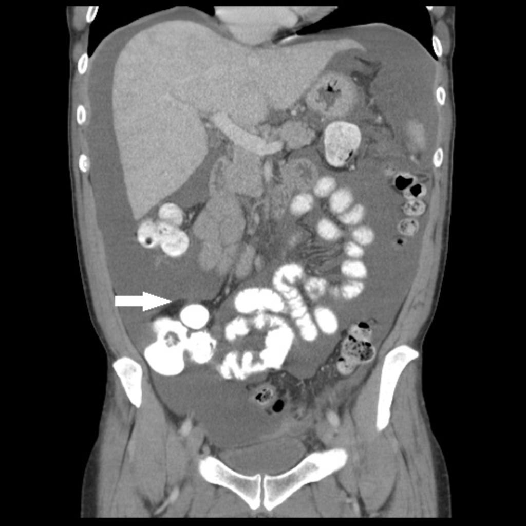 Fig. 13: Abdominopelvic CT of a patient with ascites showing that the attachment of the small bowel to the cecum (arrow)