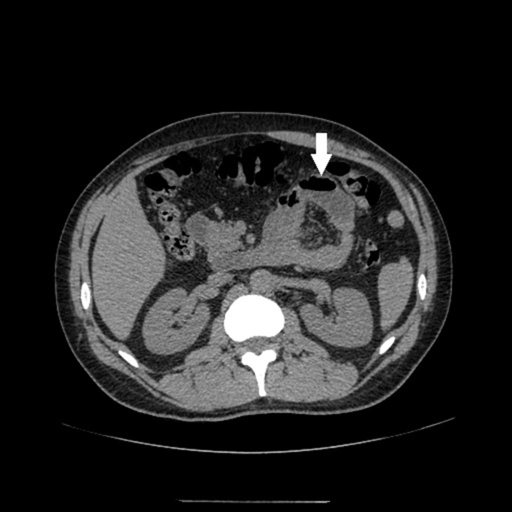 Fig. 15: Example of a pathology that can manifest in the mesentery: Abdominopelvic CT showing a closed loop and densification of the mesentery