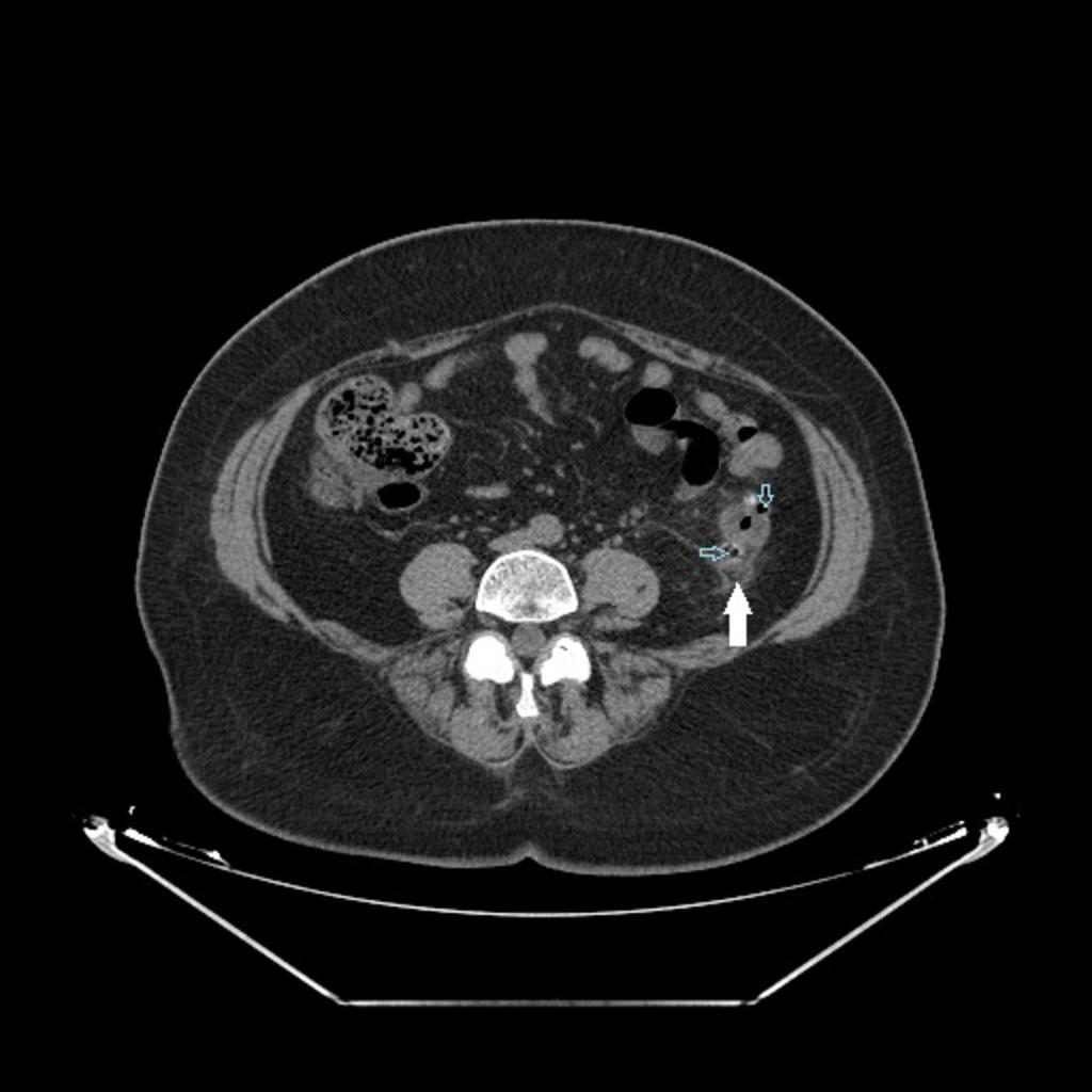 Fig. 17: Example of a pathology that can manifest in the sigmoid mesocolon: Abdominopelvic CT of a patient with abdominal pain, showing multiple