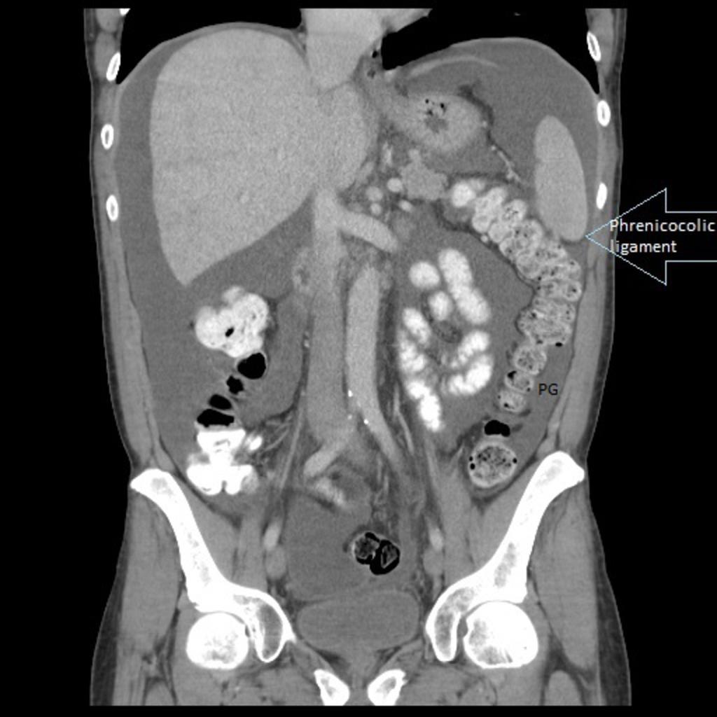 Fig. 18: Abdominopelvic CT of a patient with ascites, showing the phrenicocolic ligament, which