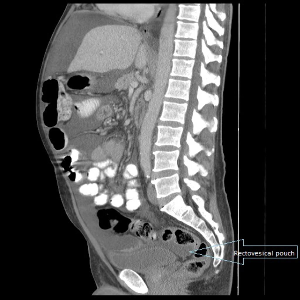 Fig. 20: Abdominopelvic CT of a male patient with