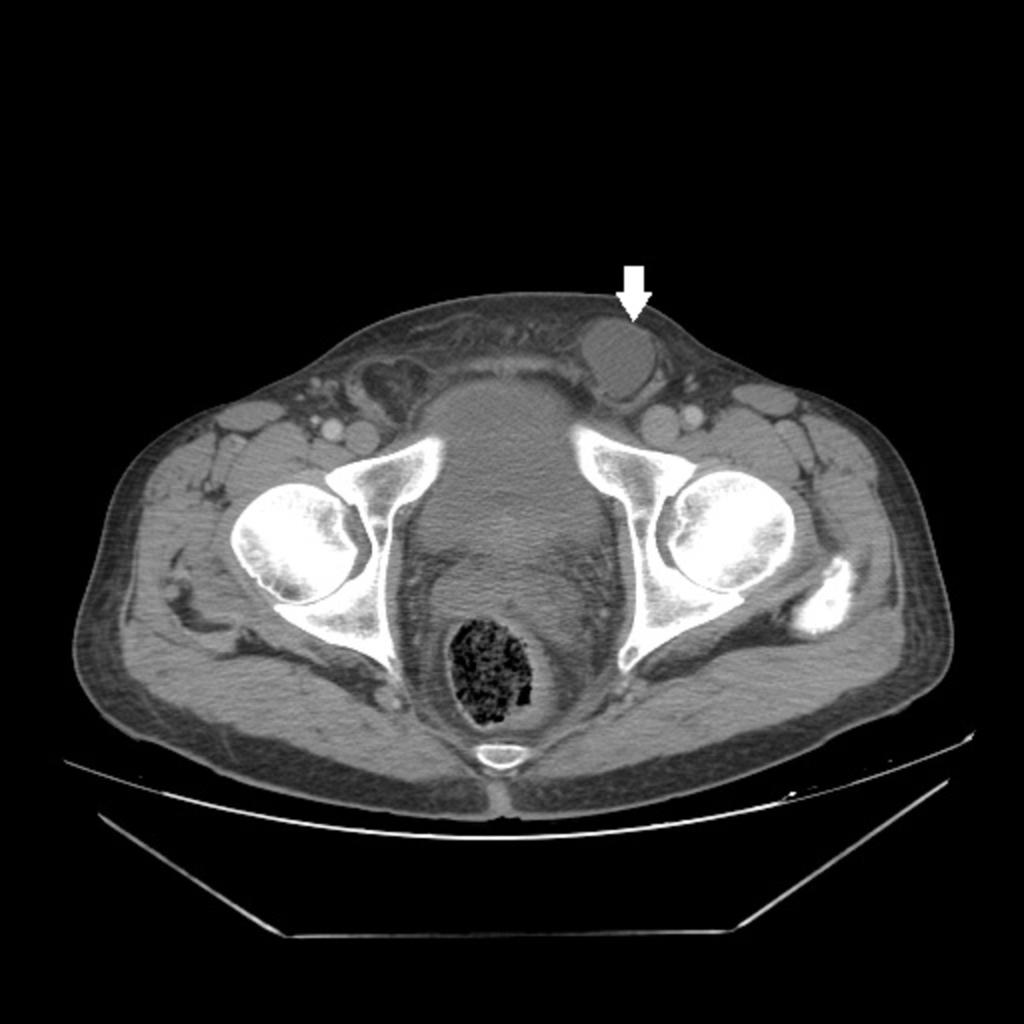 Fig. 21: Example of a pathology that can arise from the pelvic space: Abdominopelvic CT of a patient with bilateral