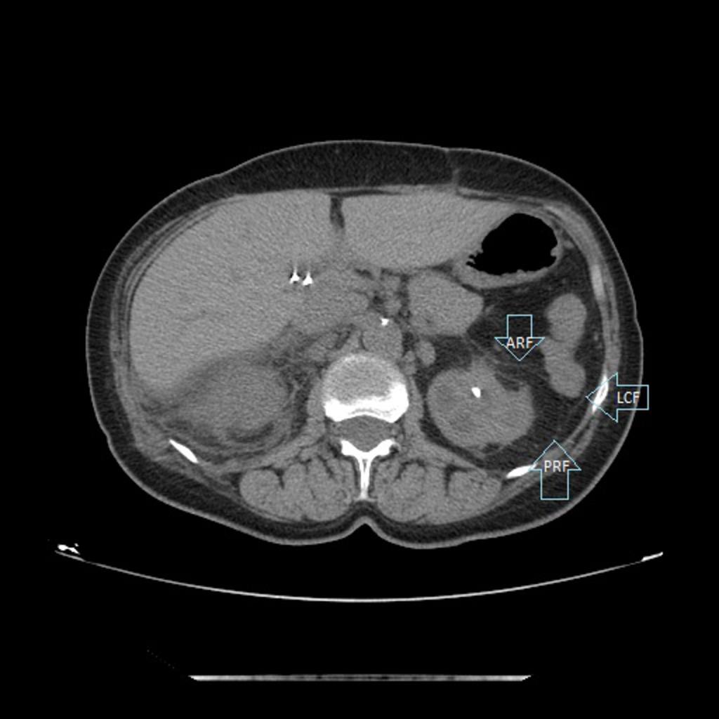 Fig. 22: Abdominopelvic CT of a patient with renal lithiasis, showing thickened fascial planes of the