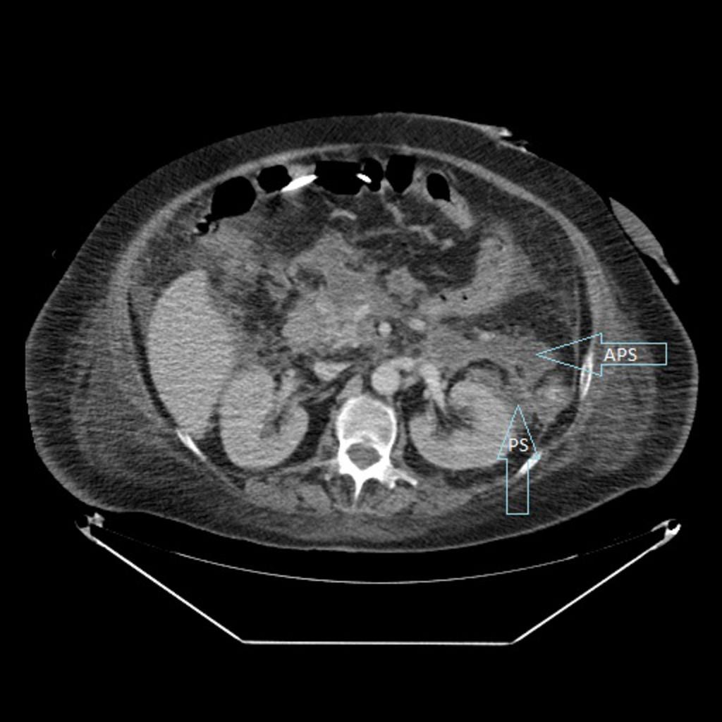 Fig. 23: Example of a pathology that can affect the anterior pararenal and perirenal spaces: Abdominopelvic CT of a patient with