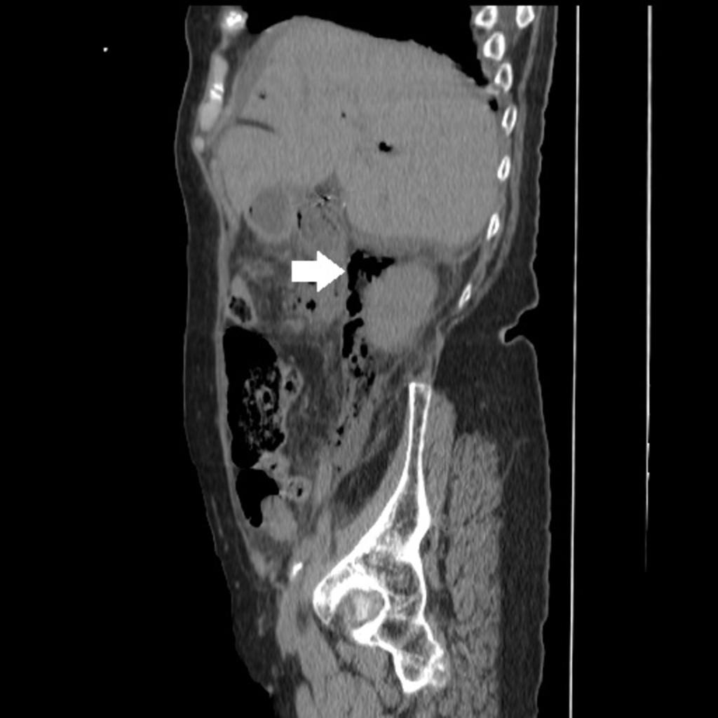 Fig. 24: Example of a condition that can be limited to the retroperitoneum: Abdominopelvic CT showing retroperitoneal air,