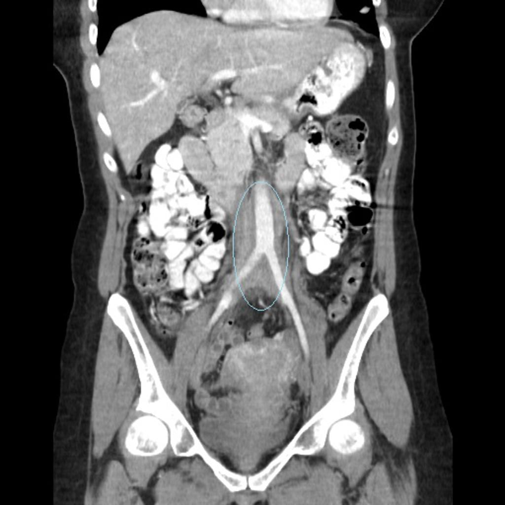 Fig. 25: Example of another pathology that can affect the retroperitoneum: Abdominopelvic