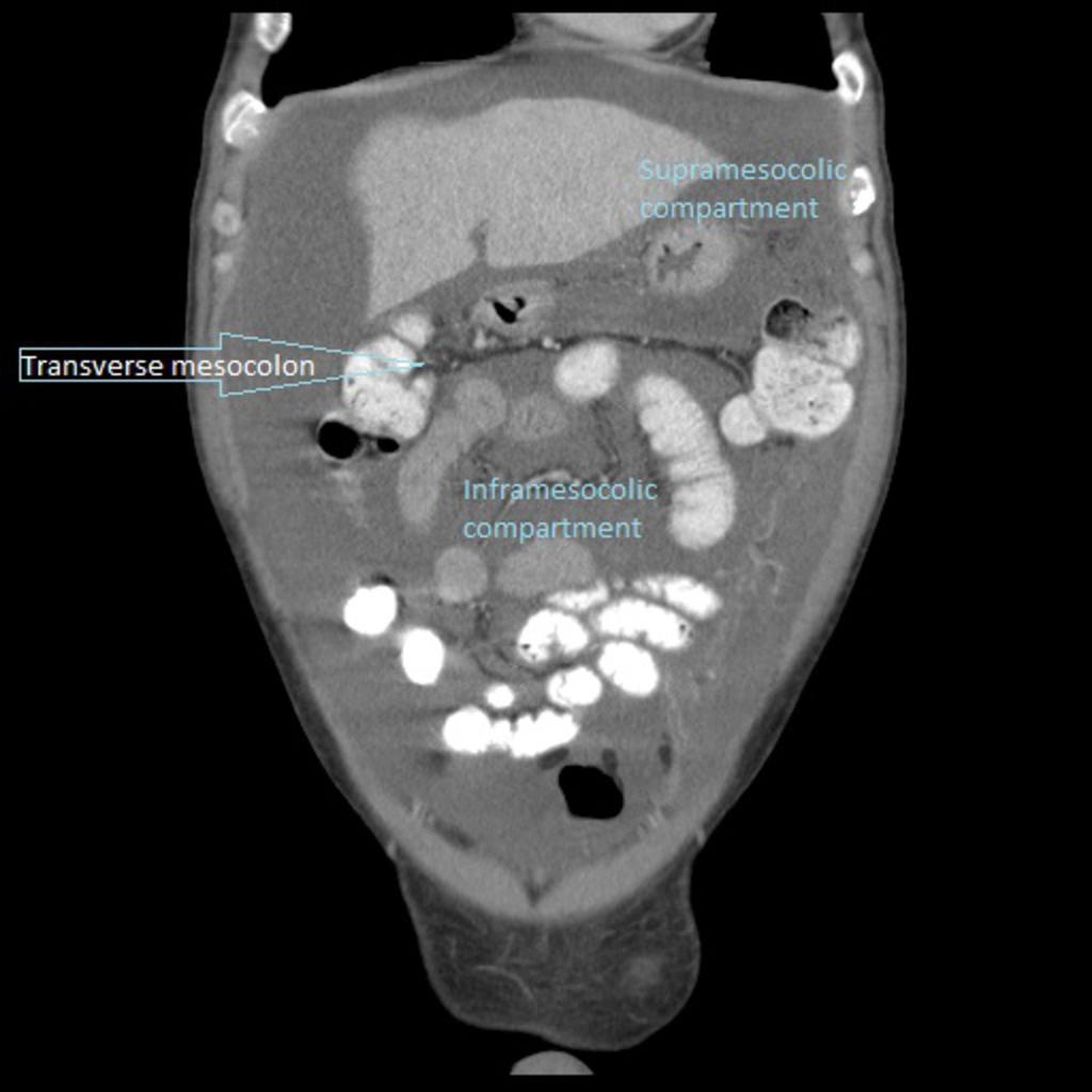 Fig. 1: Abdominopelvic CT (coronal plane) of a patient with ascites, showing the transverse