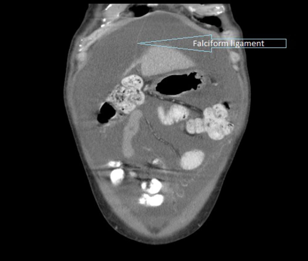 Fig. 3: Abdominopelvic CT of a patient with important ascites,