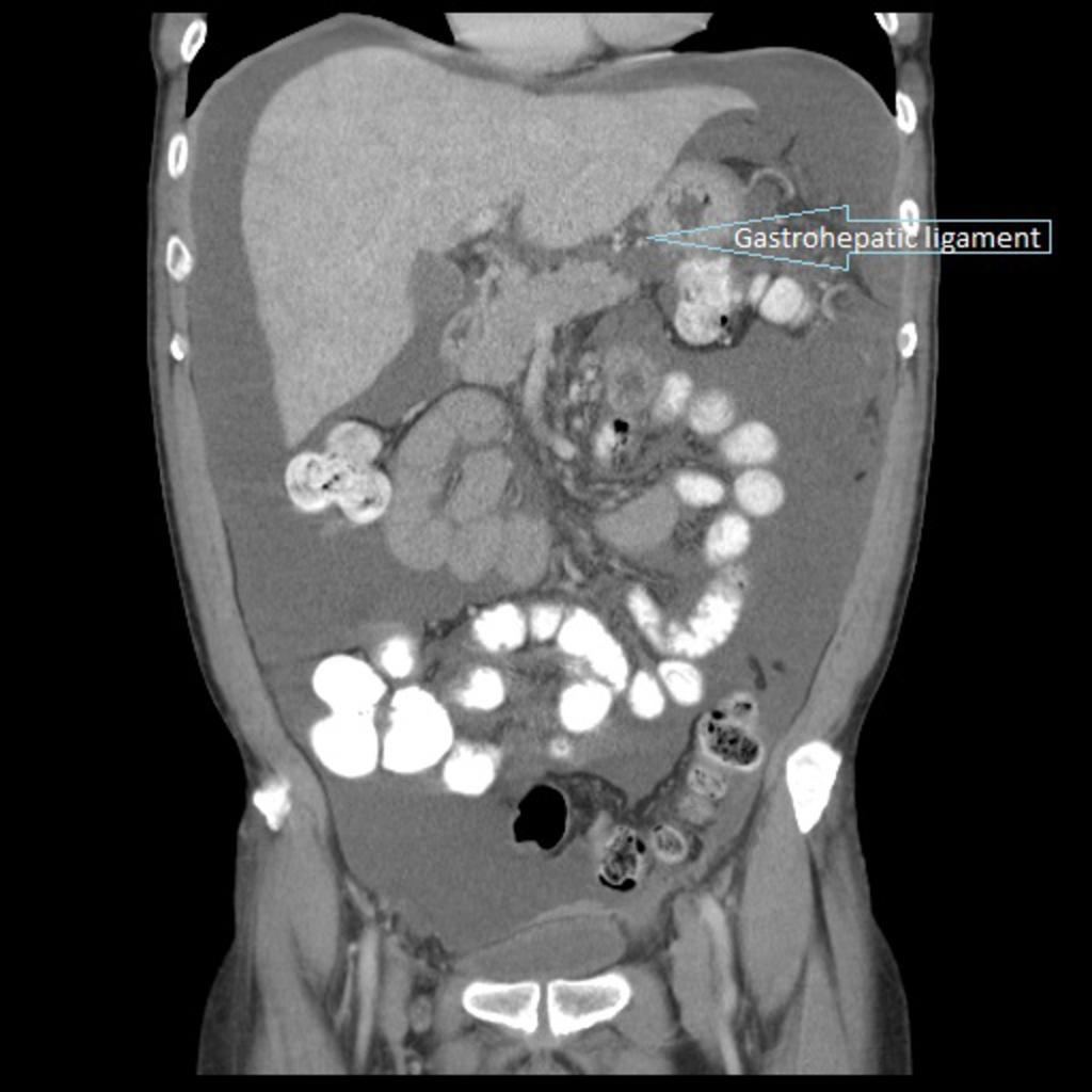 Fig. 4: Abdominopelvic CT of a patient with