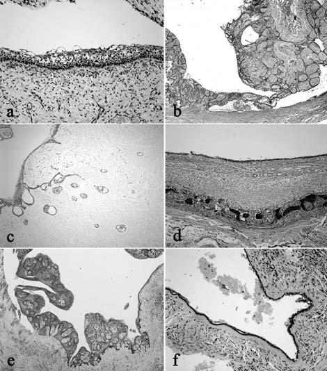 Fig 3 Various histological appearances of unicystic ameloblastoma. The epithelial lining of unicystic ameloblastoma shows, usually in part, typical features of ameloblastoma (A, H-E, x 200).