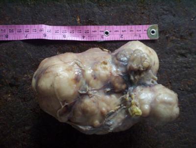 Figure 6 Fig.6 Post-operative gross specimen of submandibular gland pleomorphic adenoma. years.5 Tumors arising in the minor salivary gland account for 22% of all salivary gland neoplasm.