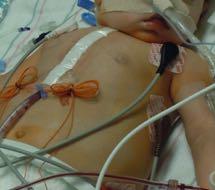 Temporary pacing in PICU Most common arrhythmias post congenital cardiac surgery involve either rate or conduction
