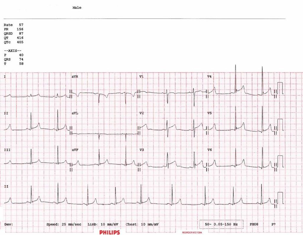 ECG During and After