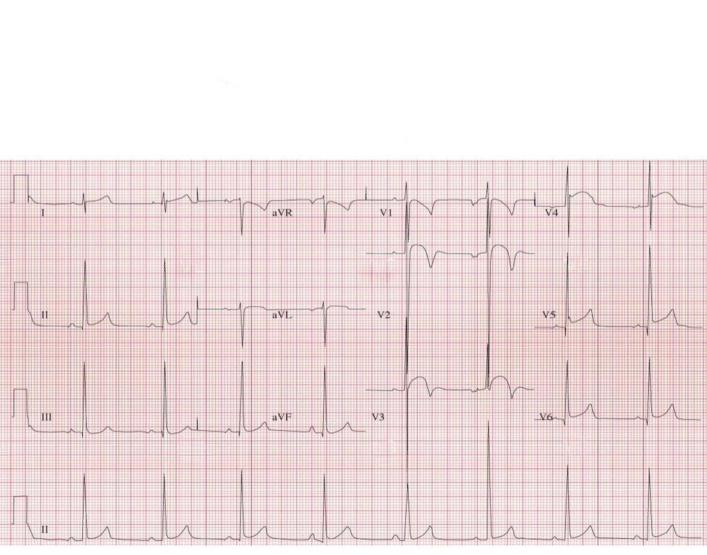 ECG Changes in a