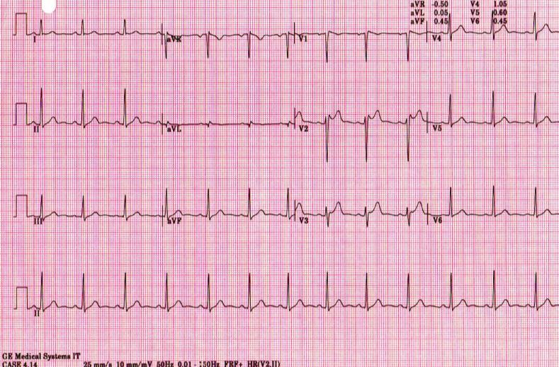 Investigation of Type 2 and 3 Brugada Pattern?Symptoms?Family history?