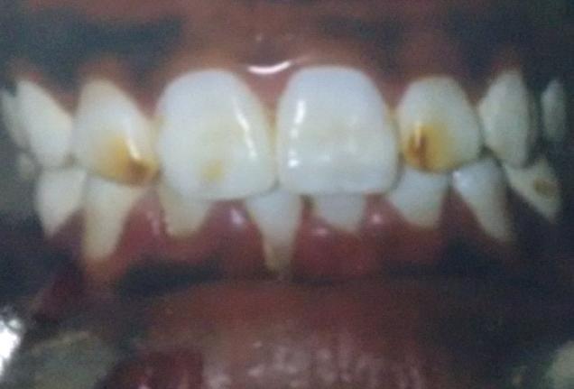 Dept.of Conservative Dentistry & Endodontic. Chhattisgarh Dental College & Research Institute, Rajnandgaon, for their guidance Fig.2..Moderate Dental Fluorsois Fig 3.