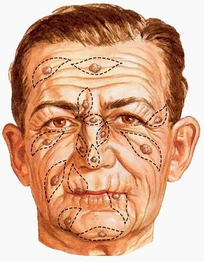 The skin of face is very thin and connected to the facial bones by loose