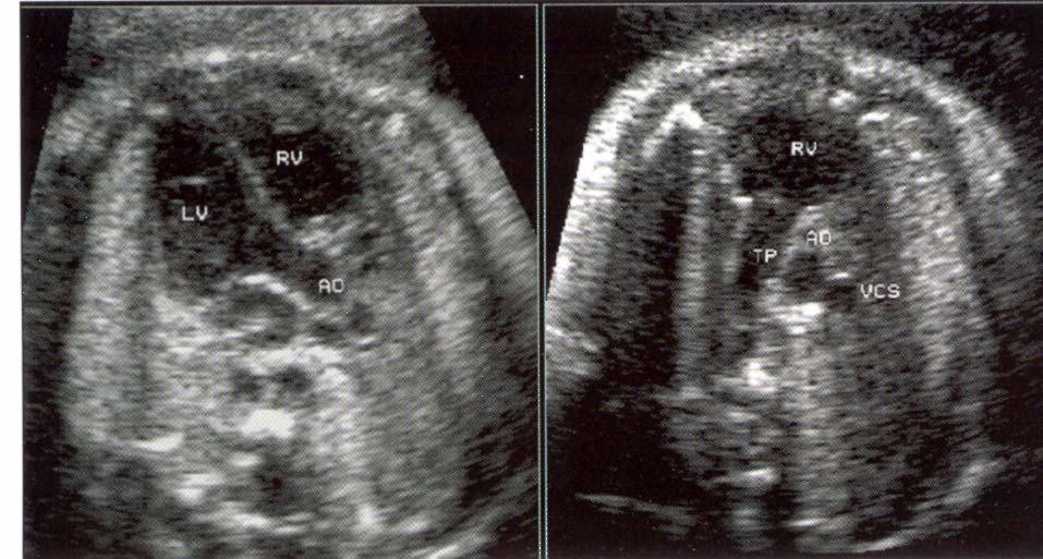 Foetal Cardiology: How