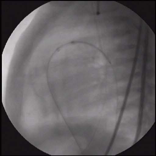 / 20 mm stent in