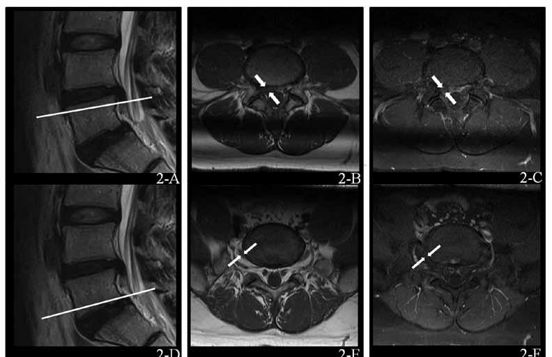 Pain Physician: March/April 2015; 18:E177-E185 Fig. 2. Non-enhanced nerve root in lumbar disc herniation.