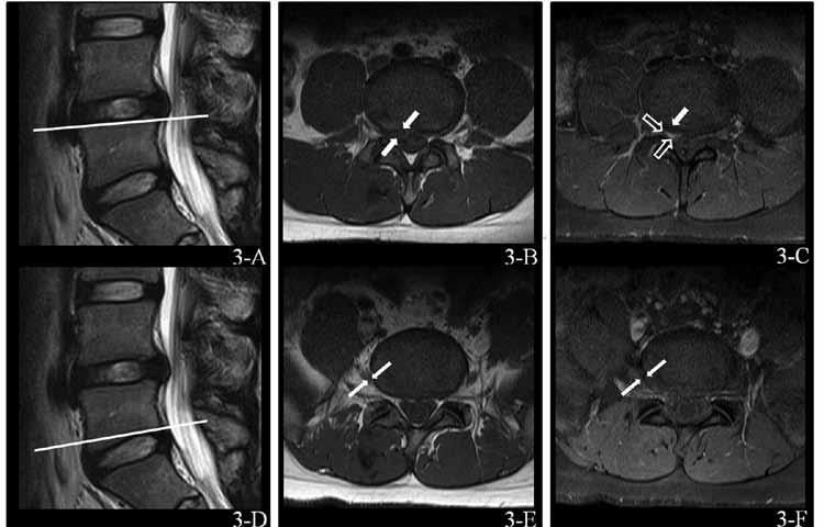 At L5 pre-dorsal root ganglionic level (2-A), axial unenhanced T1-weighted (2-B), and contrast-enhanced T1-weight image (2-C) does not show nerve root enhancement.