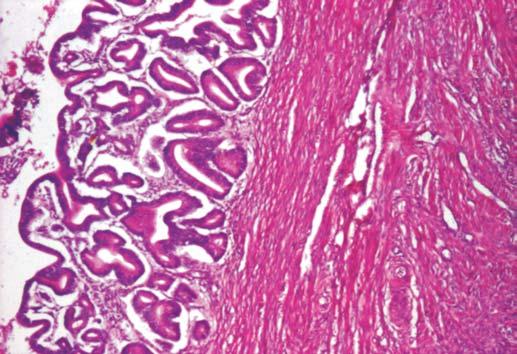 Histopatological aspects of endometroid