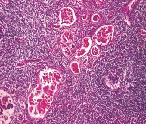 adenocarcinoma, cervical invasion Figure 8