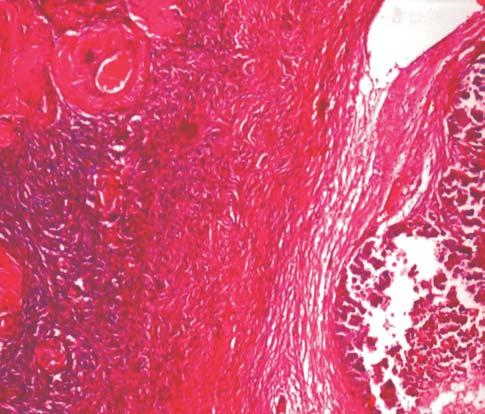 differentiated endometroid adenocarcinoma