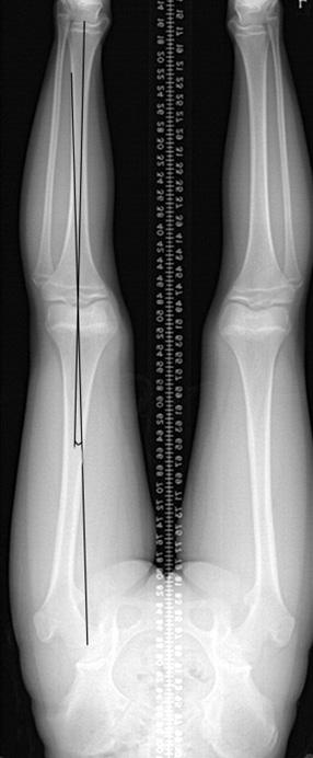 PLH on only the proximal tibia has an expectedly weaker correction power than PLH on both the distal femur and proximal tibia.