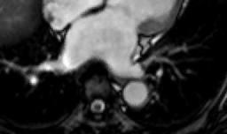 by cine MRI in relation to severity of fibrosis on LGE MRI Time volume curve of LV measured by cine MRI 14 12