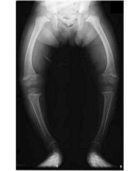 Tibial varum This is how much bend (bowing) there is in the tibia.