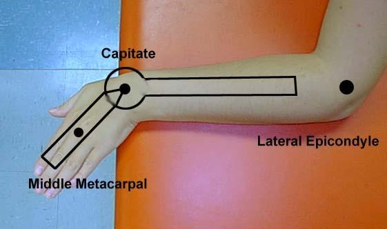 Palpable immediately proximal to the base of the 3rd metacarpal.