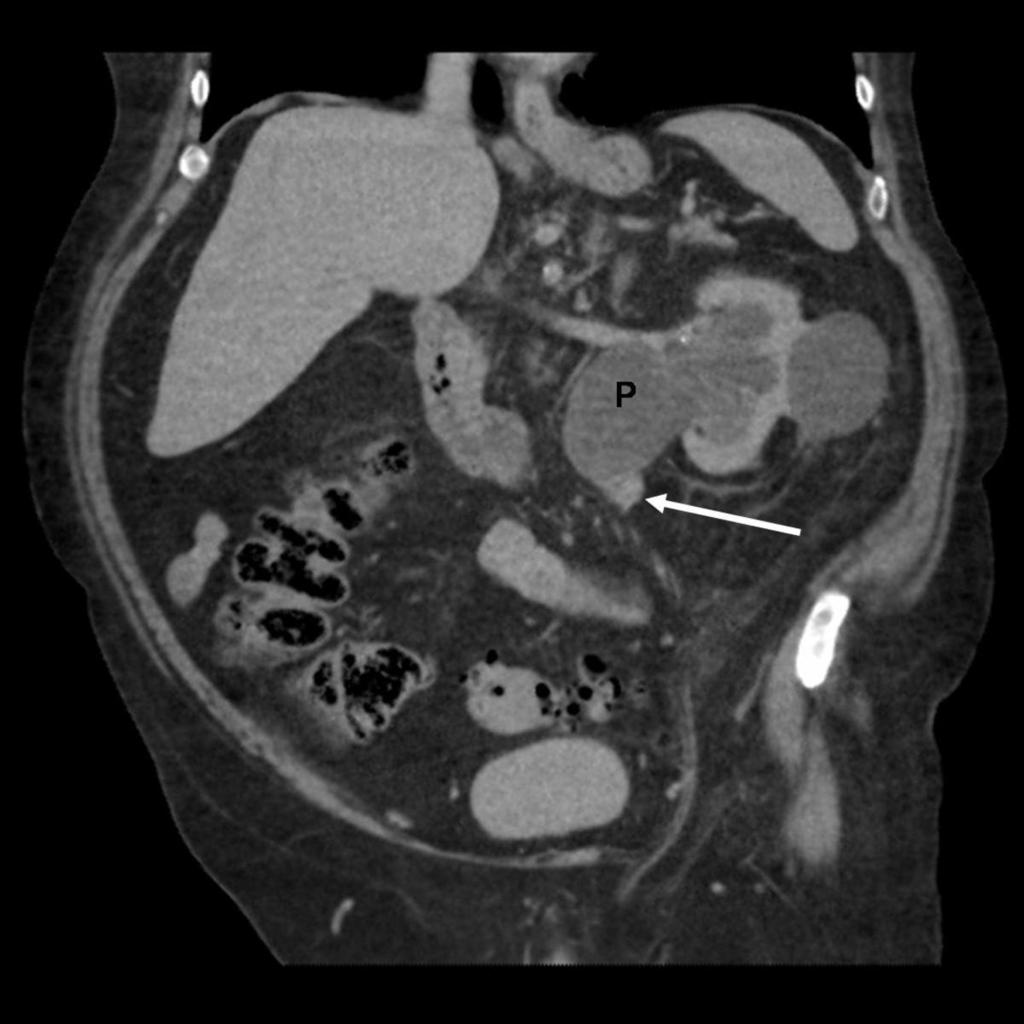 Fig. 6: Coronal CTU reformat shows a non-opacified (completely obstructed) left collecting system and extra-renal pelvis (P) with