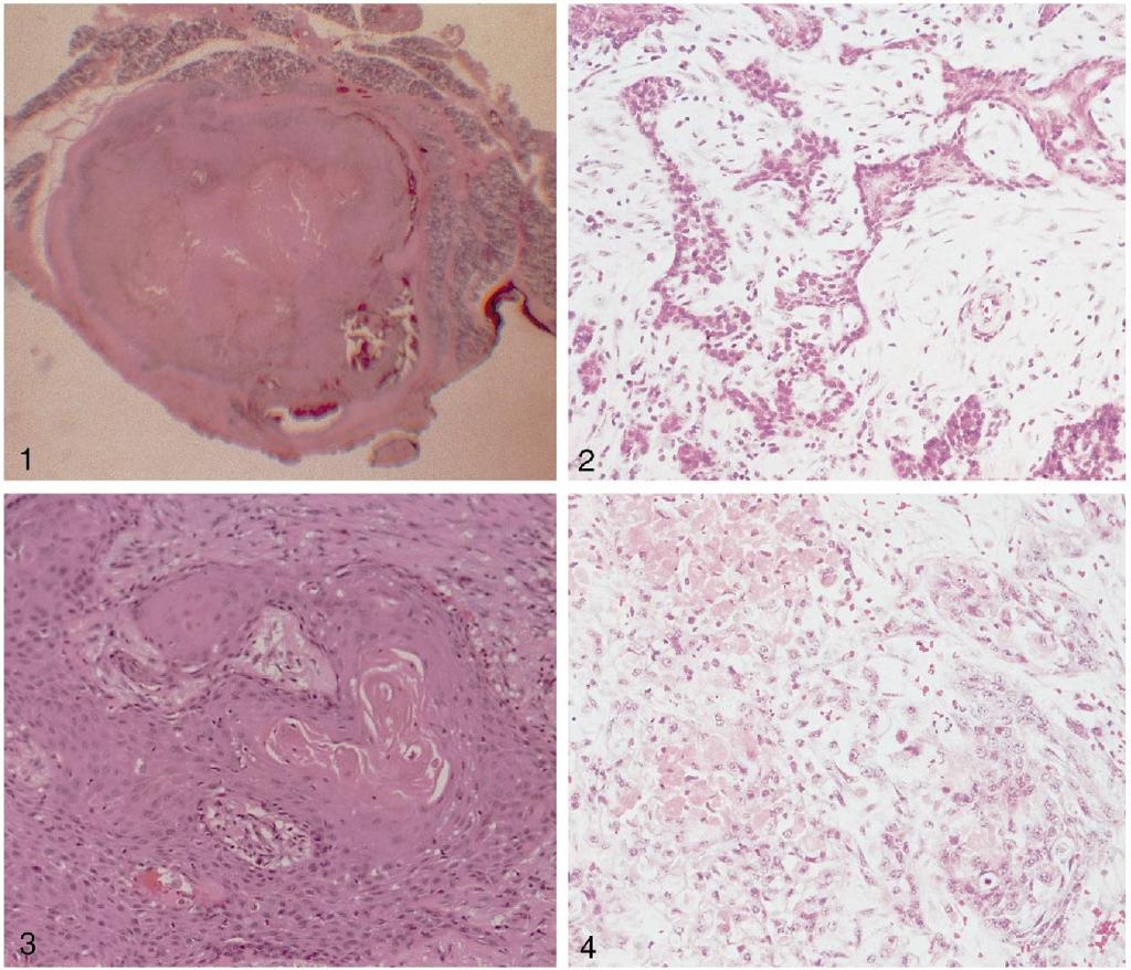 Figure 1. Case 1. A well-circumscribed pleomorphic adenoma with a thick fibrous capsule and extensive central necrosis (hematoxylin-eosin, original magnification 2.5). Figure 2. Case 2.