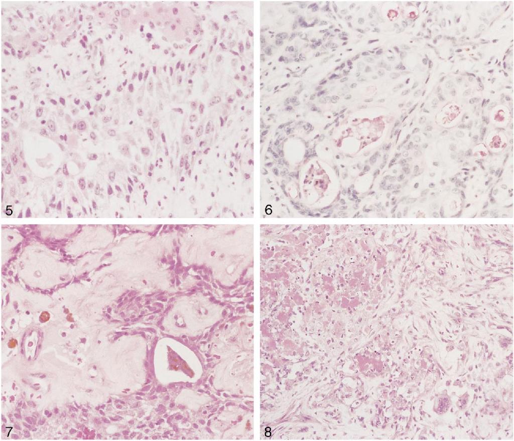 Figure 5. Case 4. Transition from oncocytic adenoma to metaplastic squamous epithelium (hematoxylin-eosin, original magnification 100). Figure 6. Case 1.