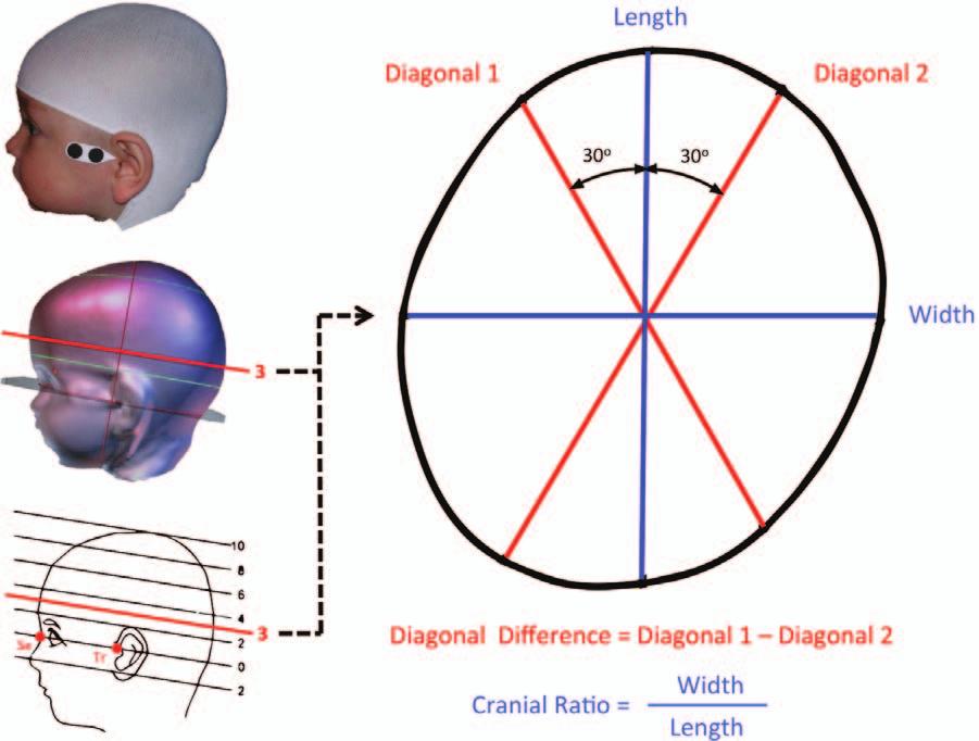 Plastic and Reconstructive Surgery March 2015 Fig. 2. Cranial measurements obtained with a three-dimensional laser surface scanner. (Above, left) Photograph of child with stockinet and markers.