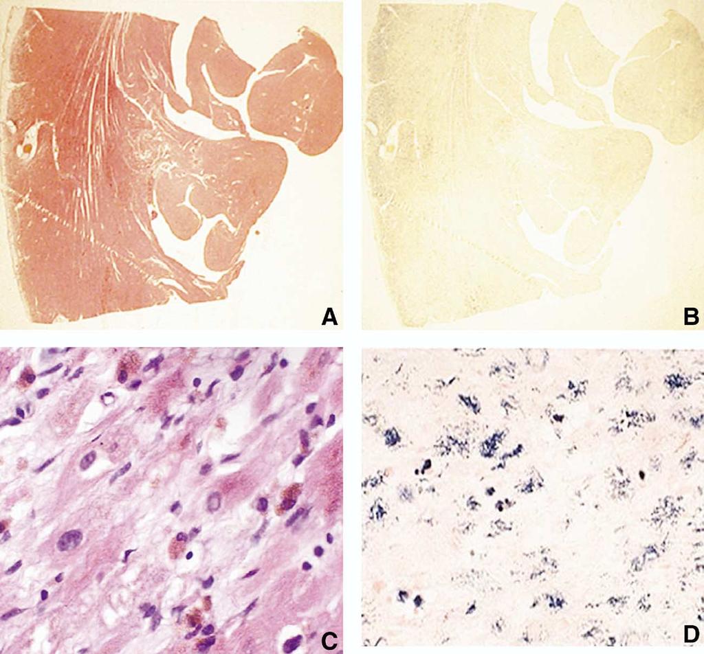 October 2005 HEMOCHROMATOSIS 951 Figure 4. Histologic appearances in juvenile hemochromatosis. Sections from the heart of a 27-year-old woman who underwent heart transplantation for cardiac failure.