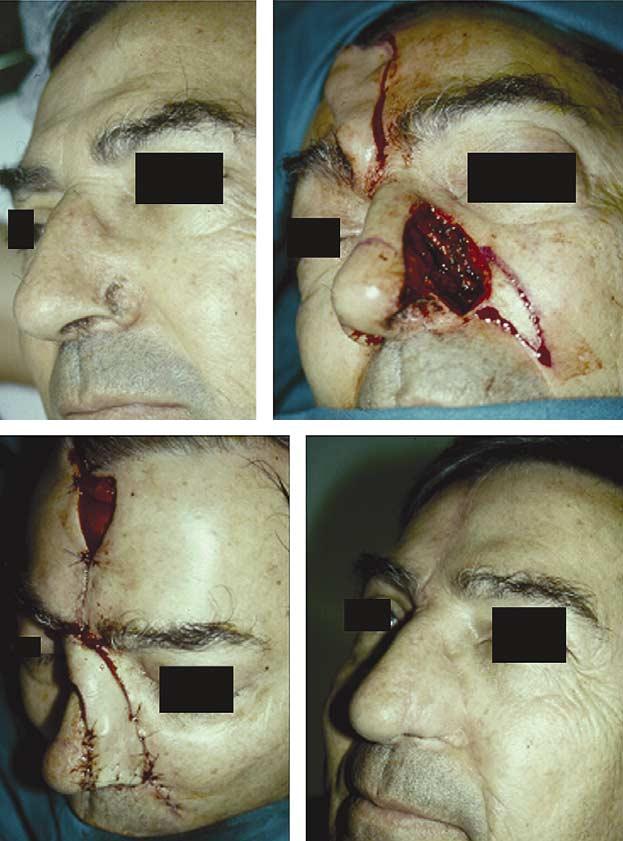 surgical procedures have been described in medical literature to perform nasal reconstruction.