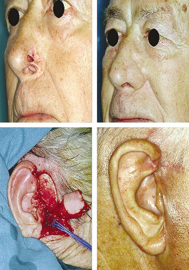 246 T. Yoon et al. remodel the flap re-elevating it off the defect under local anesthesia. When dealing with cocaine abuse sequela reconstruction we assume we are working with ischemic tissues.