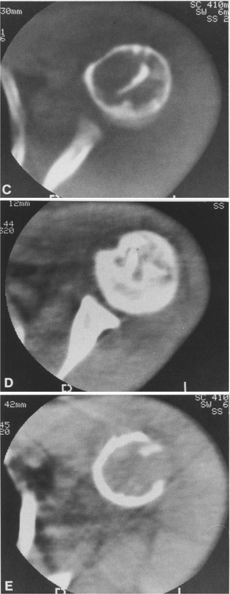 Note multiple fallen fragments contained within this large active cyst. B The oblique view demonstrates a large cortical defect suggesting a malignant lesion.