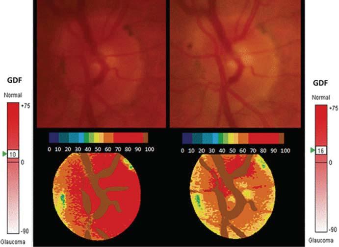 10 Measuring Hemoglobin Levels in the Optic Nerve Head for Glaucoma Management 273 Fig. 10.
